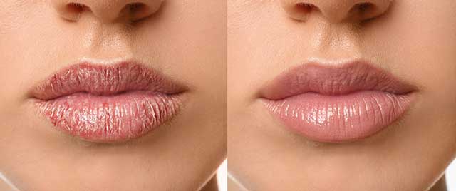 treatment of dry lips